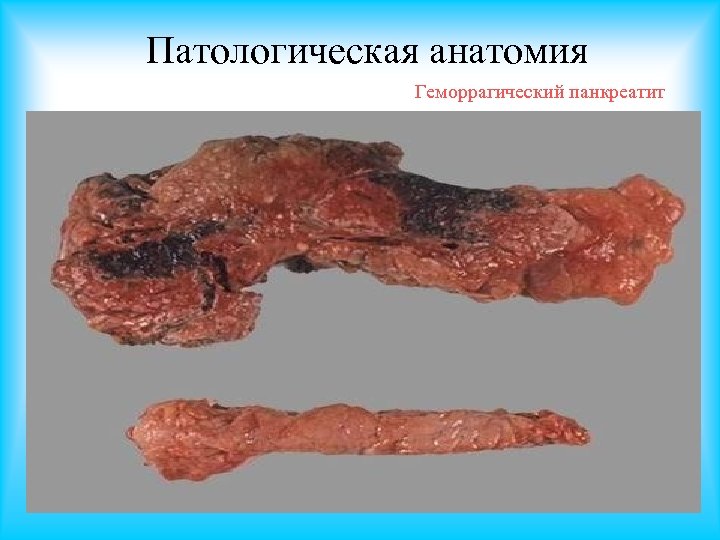 Патологическая анатомия Геморрагический панкреатит 