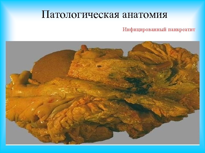 Патологическая анатомия Инфицированный панкреатит 