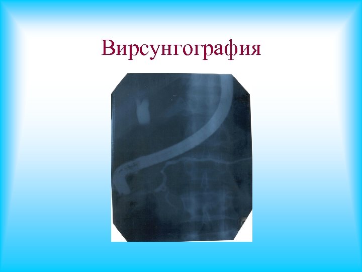 Вирсунгография 