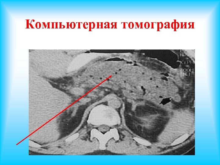 Компьютерная томография 