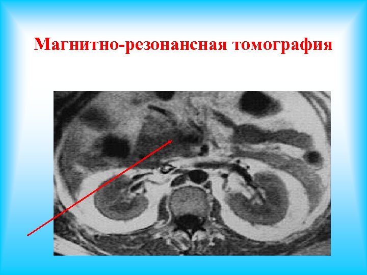 Проблемы со стулом при панкреатите