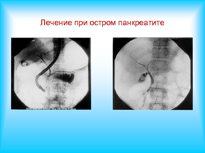 Лечение при остром панкреатите 