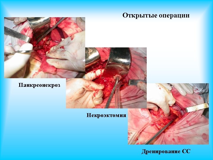 Открытые операции Панкреонекроз Некроэктомия Дренирование СС 