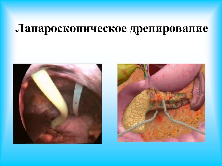 Лапароскопическое дренирование 