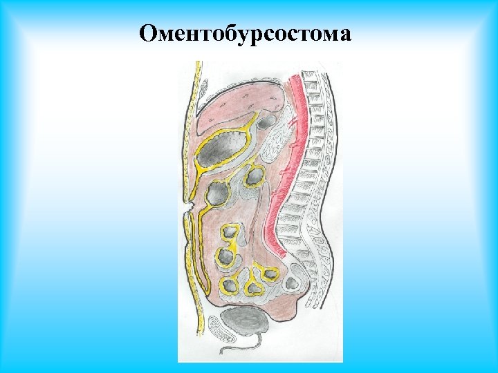 Оментобурсостома 