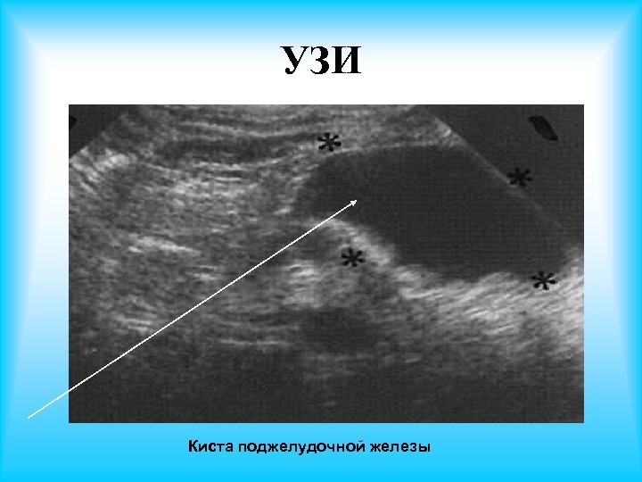 УЗИ Киста поджелудочной железы 