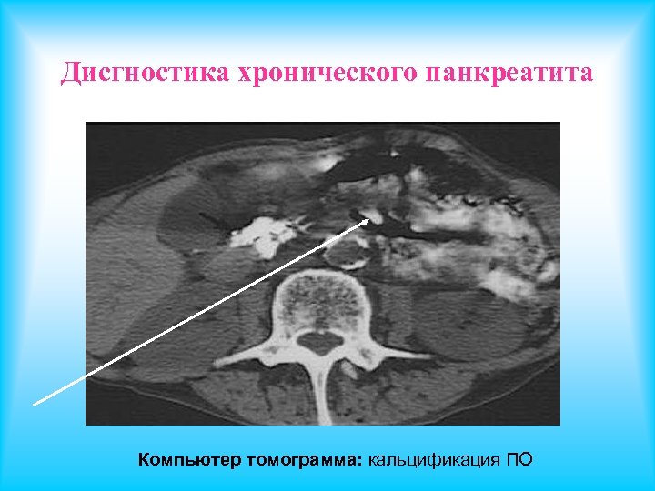 Дисгностика хронического панкреатита Компьютер томограмма: кальцификация ПО 