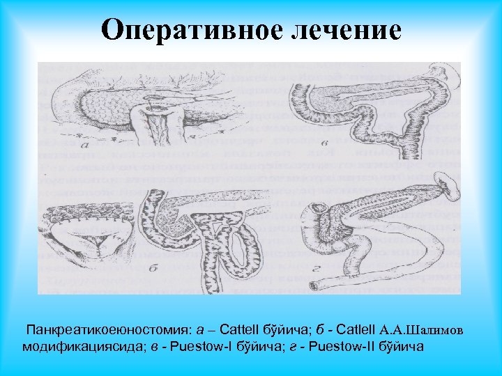 Оперативное лечение Панкреатикоеюностомия: а – Cattell бўйича; б - Catlell А. А. Шалимов модификациясида;