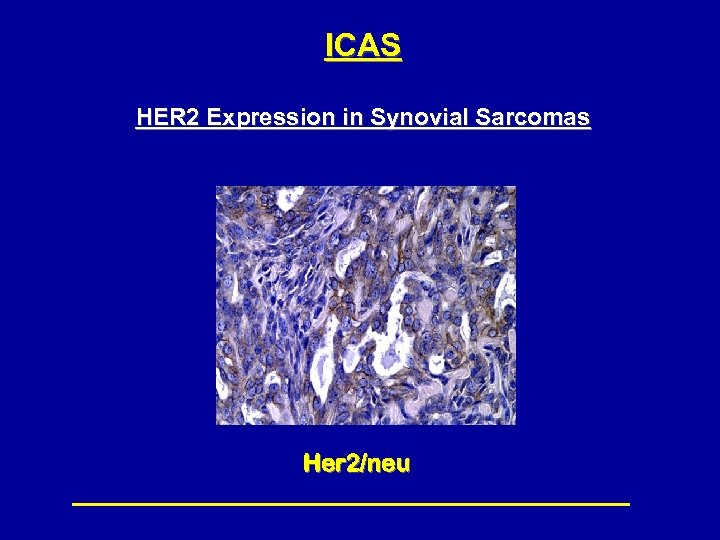 ICAS HER 2 Expression in Synovial Sarcomas Her 2/neu 