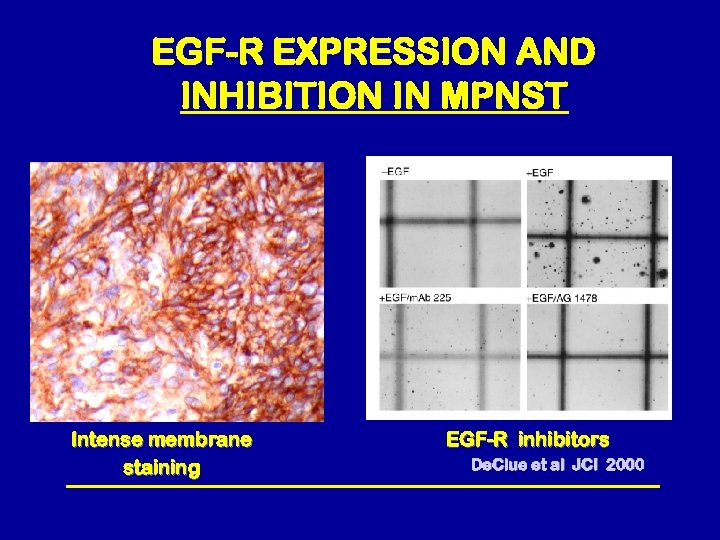 EGF-R EXPRESSION AND INHIBITION IN MPNST Intense membrane staining EGF-R inhibitors De. Clue et