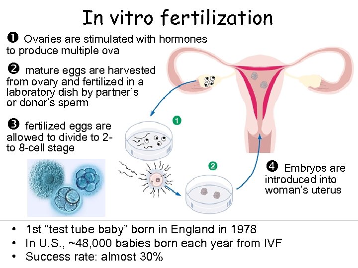 In vitro fertilization Ovaries are stimulated with hormones to produce multiple ova mature eggs