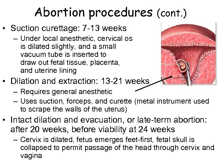 Abortion procedures (cont. ) • Suction curettage: 7 -13 weeks – Under local anesthetic,