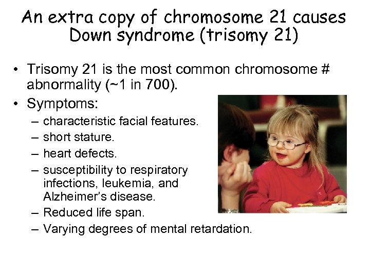 An extra copy of chromosome 21 causes Down syndrome (trisomy 21) • Trisomy 21
