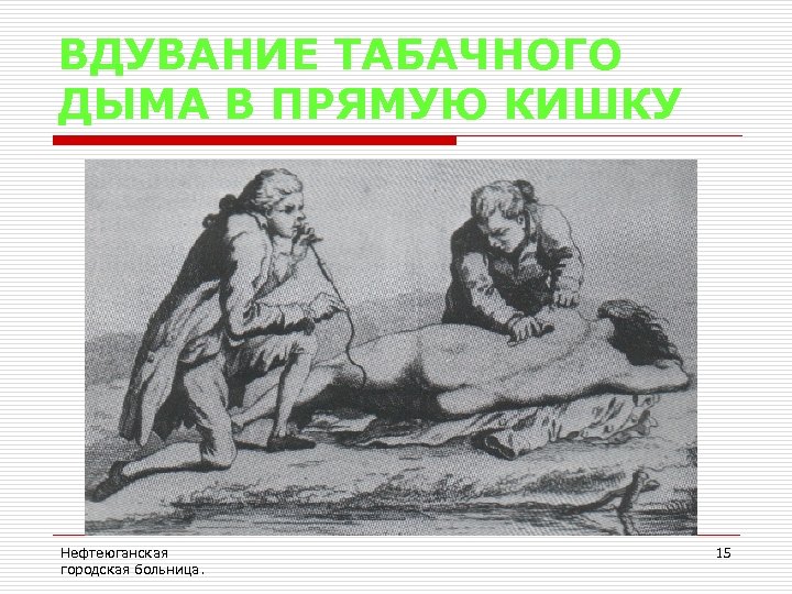 ВДУВАНИЕ ТАБАЧНОГО ДЫМА В ПРЯМУЮ КИШКУ Нефтеюганская городская больница. 15 