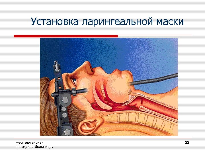 Установка ларингеальной маски Нефтеюганская городская больница. 33 