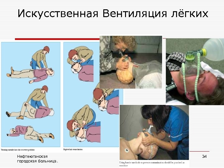 Искусственная Вентиляция лёгких Нефтеюганская городская больница. 34 