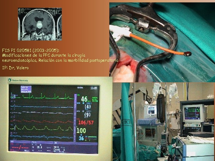 FIS PI 020581 (2003 -2005): Modificaciones de la PPC durante la cirugía neuroendoscópica. Relación