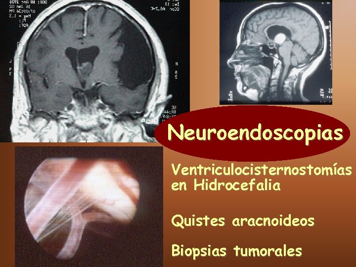 Neuroendoscopias Ventriculocisternostomías en Hidrocefalia Quistes aracnoideos Biopsias tumorales 