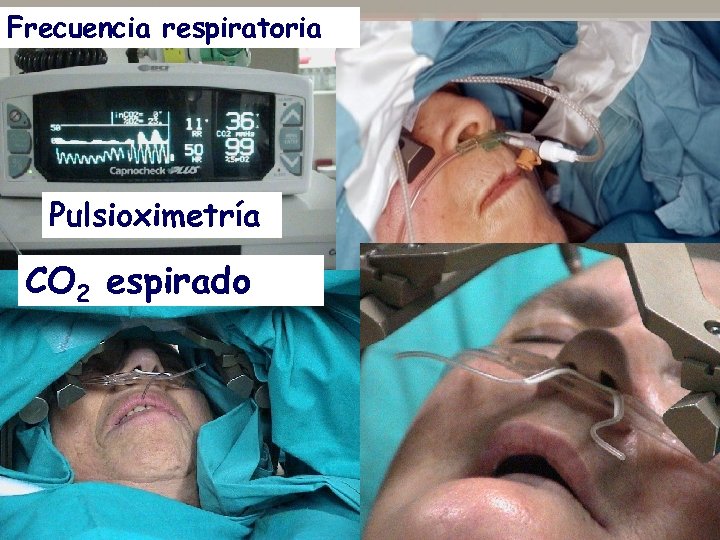 Frecuencia respiratoria Pulsioximetría CO 2 espirado 