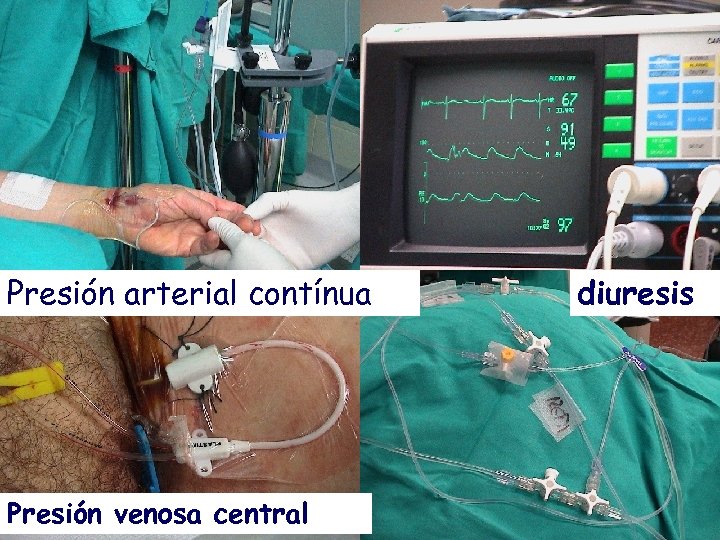 Presión arterial contínua Presión venosa central diuresis 