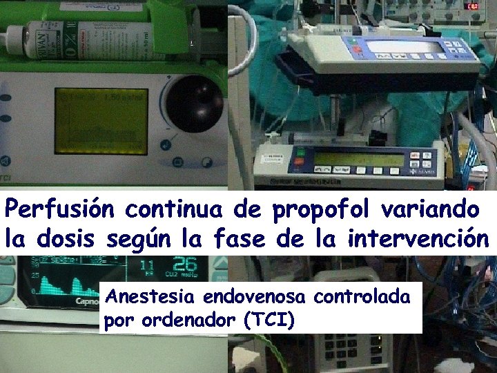 Perfusión continua de propofol variando la dosis según la fase de la intervención Anestesia