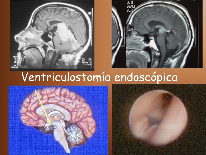 Ventriculostomía endoscópica 