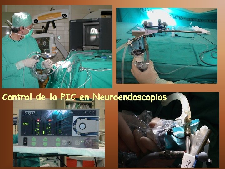 Control de la PIC en Neuroendoscopias 