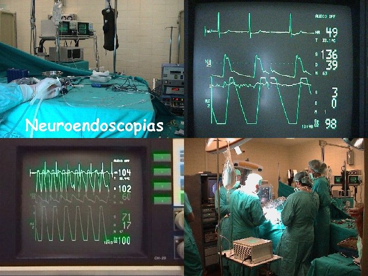 Neuroendoscopias 