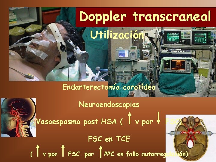 Doppler transcraneal Utilización Endarterectomía carotídea Neuroendoscopias Vasoespasmo post HSA ( v por FSC) FSC