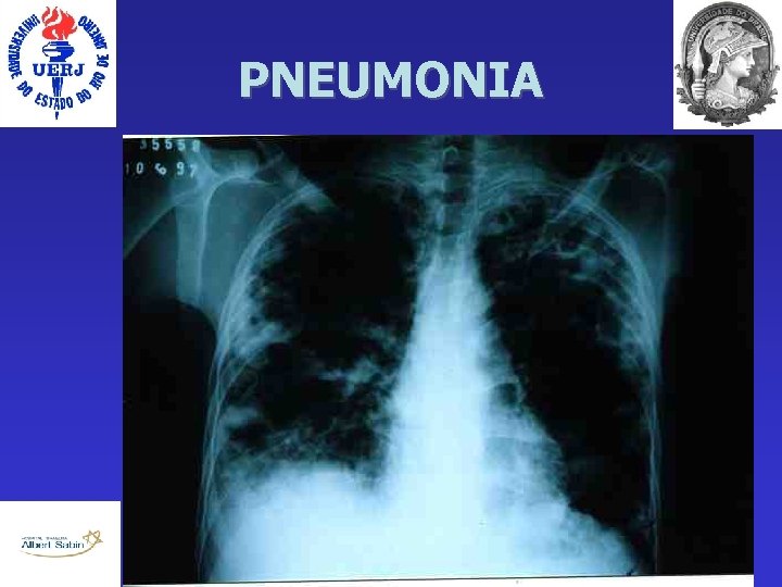 PNEUMONIA 