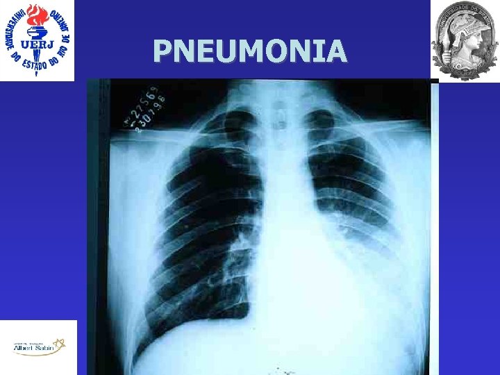 PNEUMONIA 
