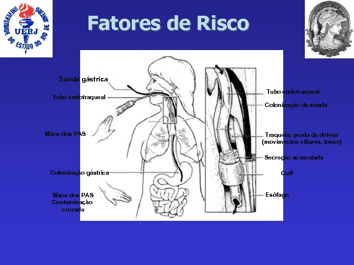 Fatores de Risco Sonda gástrica Tubo endotraqueal Colonização da sonda Mãos dos PAS Traquéia:
