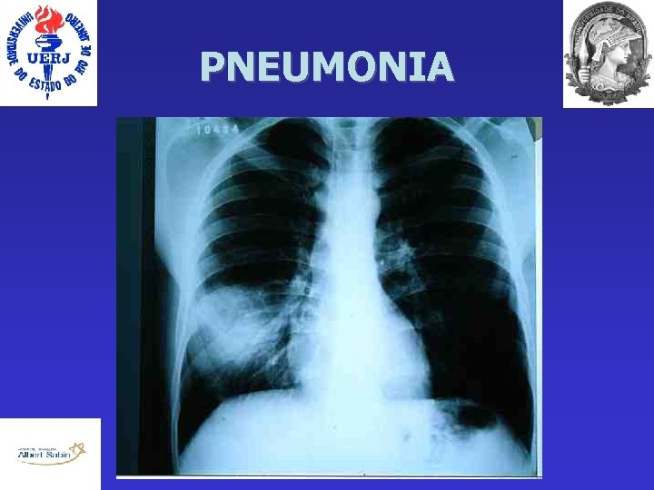 PNEUMONIA 