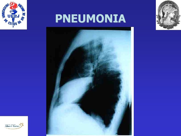 PNEUMONIA 