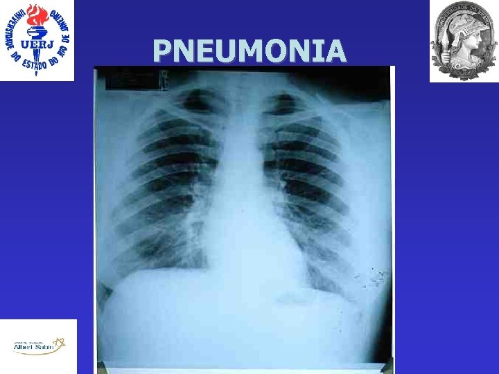 PNEUMONIA 