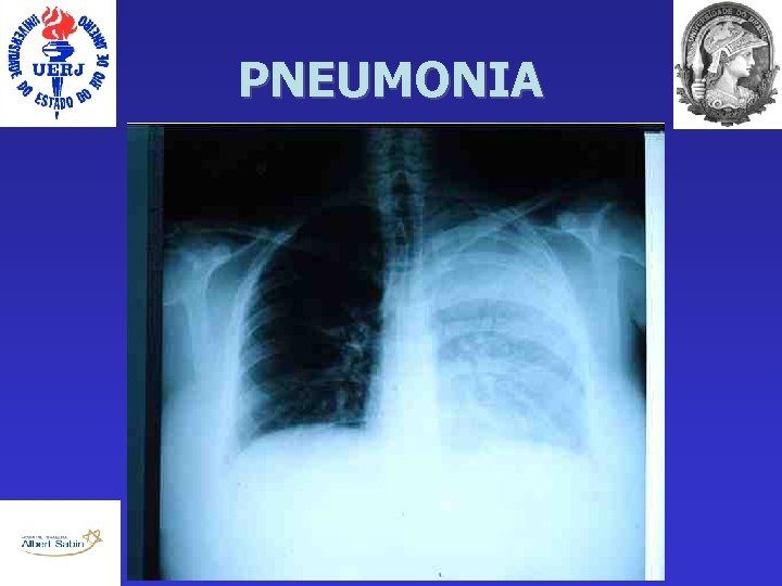 PNEUMONIA 