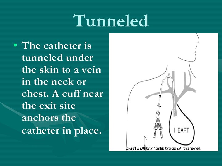 24 core tunnel catheter
