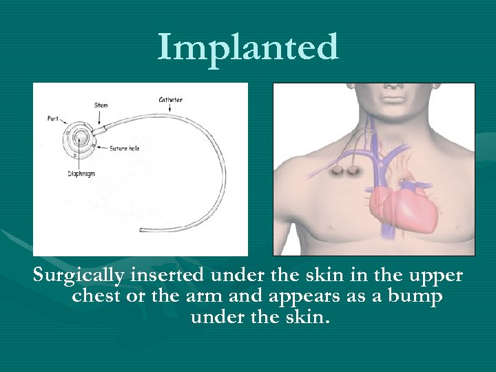 Implanted Surgically inserted under the skin in the upper chest or the arm and