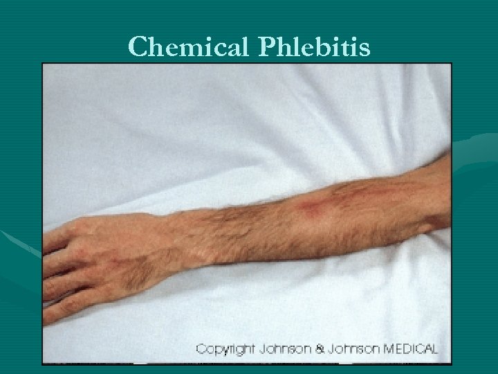 Chemical Phlebitis 