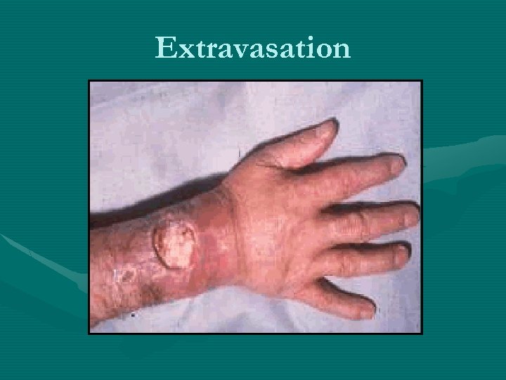 Extravasation 