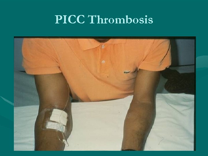 PICC Thrombosis 