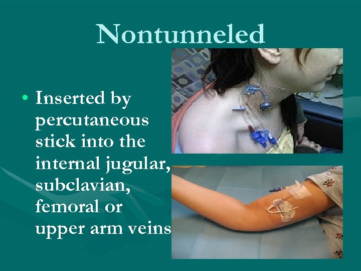 Nontunneled • Inserted by percutaneous stick into the internal jugular, subclavian, femoral or upper