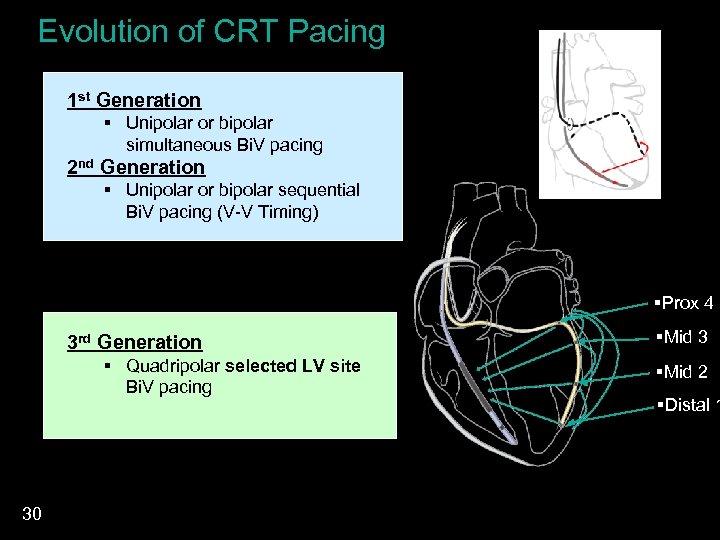 Evolution of CRT Pacing 1 st Generation § Unipolar or bipolar simultaneous Bi. V