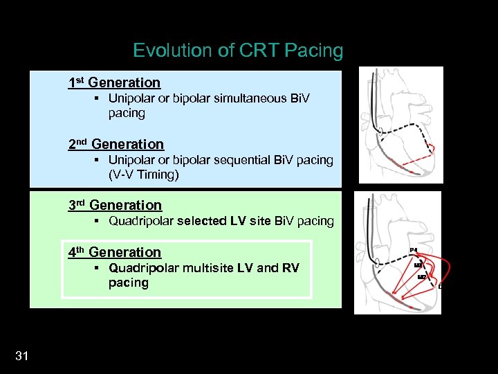 Evolution of CRT Pacing 1 st Generation § Unipolar or bipolar simultaneous Bi. V