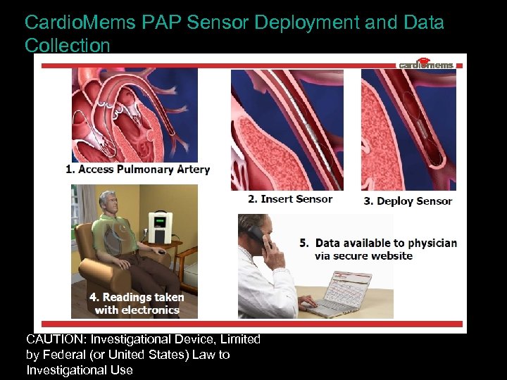 Cardio. Mems PAP Sensor Deployment and Data Collection CAUTION: Investigational Device, Limited by Federal