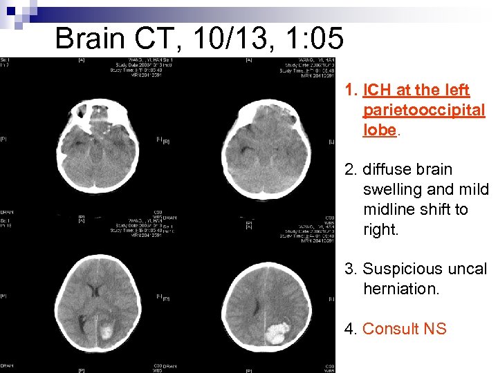 Brain CT, 10/13, 1: 05 1. ICH at the left parietooccipital lobe. 2. diffuse