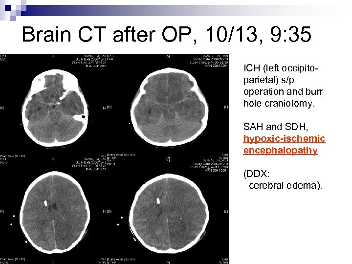 Brain CT after OP, 10/13, 9: 35 ICH (left occipitoparietal) s/p operation and burr