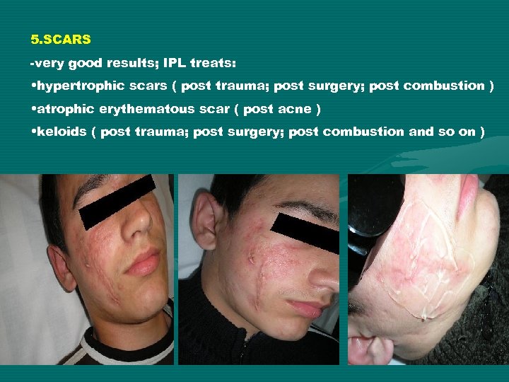 5. SCARS -very good results; IPL treats: • hypertrophic scars ( post trauma; post