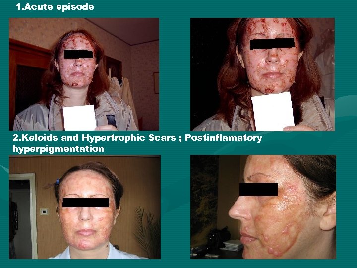1. Acute episode 2. Keloids and Hypertrophic Scars ; Postinflamatory hyperpigmentation 