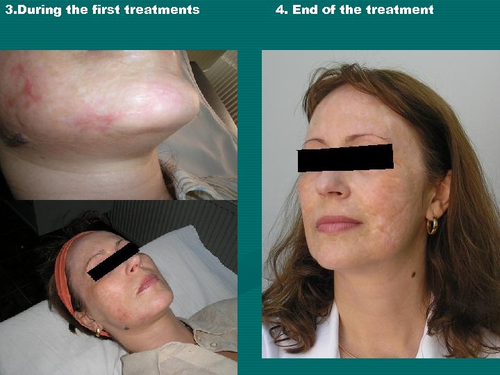 3. During the first treatments 4. End of the treatment 